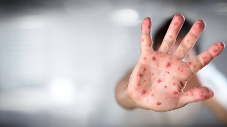 آبله میمون از طریق هوا منتقل می&zwnj;شود؟