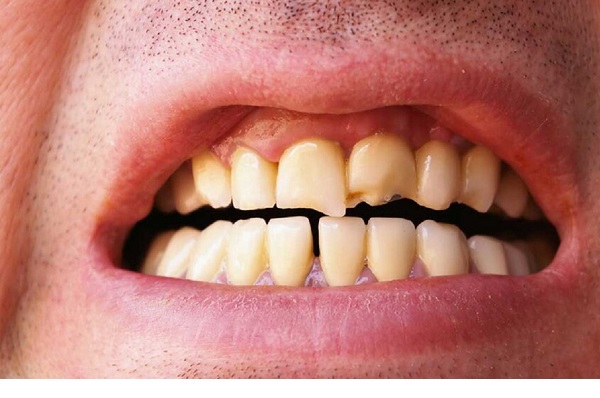 هفت عادت مضر برای سلامت دندان&zwnj;ها